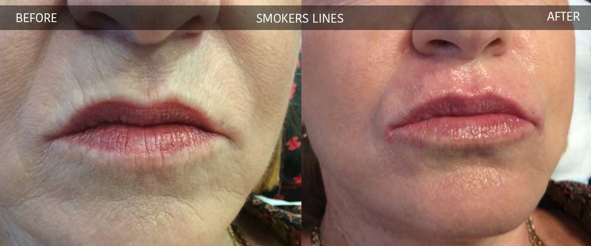 Smokers Lips Before And After