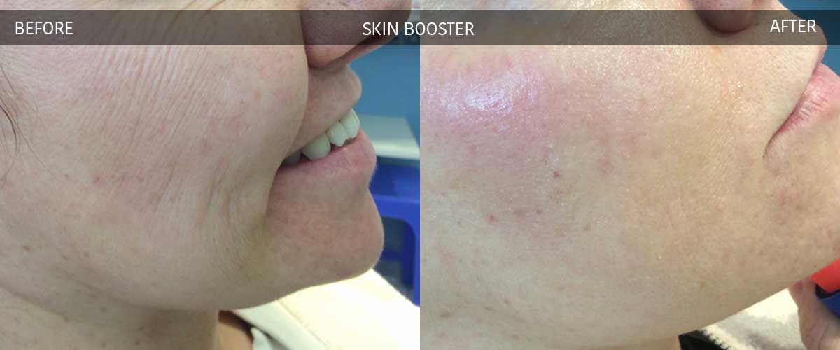Skin Booster - Cosmetic Treatments - Crows Nest Cosmetic & Vein Clinic Sydney