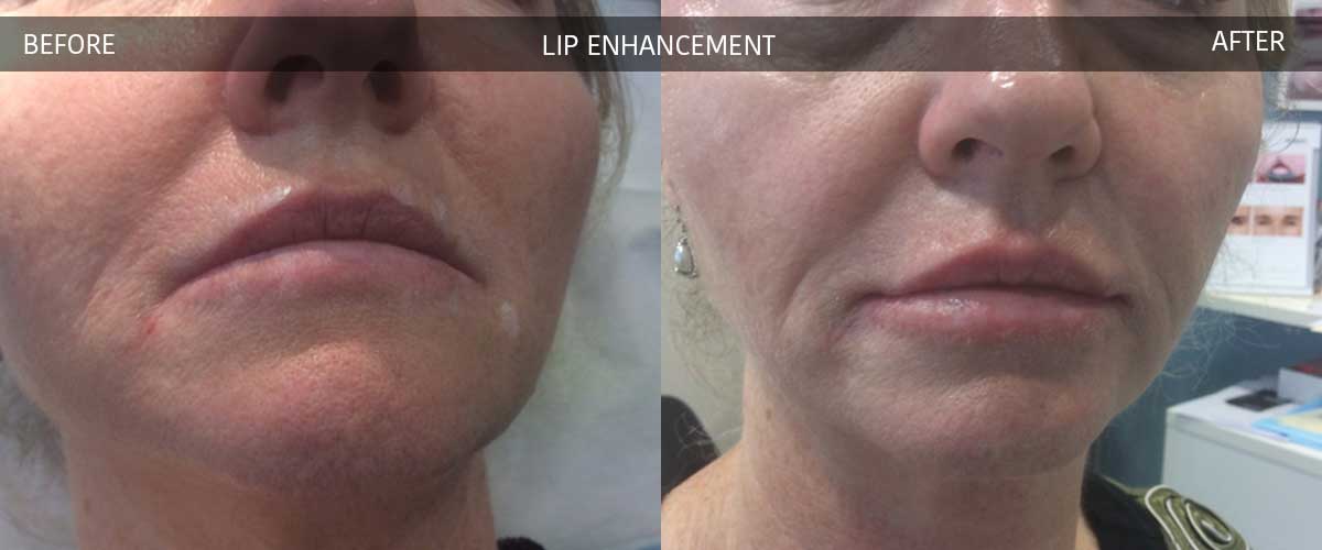 Lip Enhancement - Cosmetic Treatments - Crows Nest Cosmetic & Vein Clinic Sydney