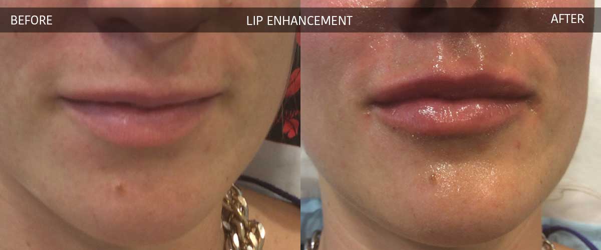 Lip Enhancement - Cosmetic Treatments - Crows Nest Cosmetic & Vein Clinic Sydney