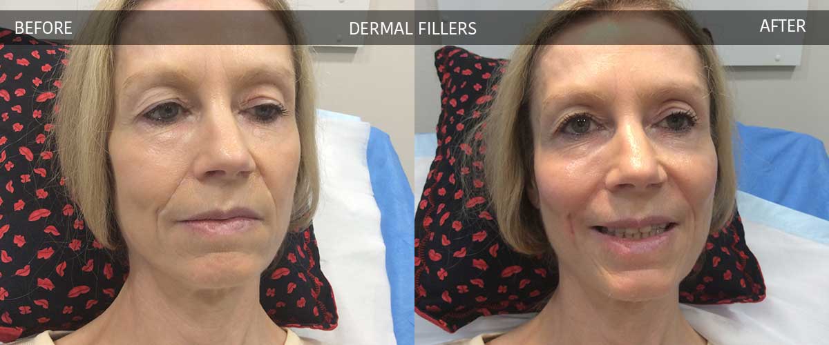 Dermal Fillers - Skin Treatments - Crows Nest Cosmetic Clinic