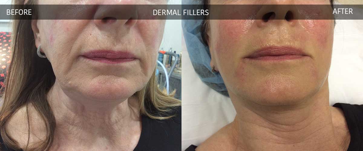 Dermal Fillers - Skin Treatments - Crows Nest Cosmetic Clinic