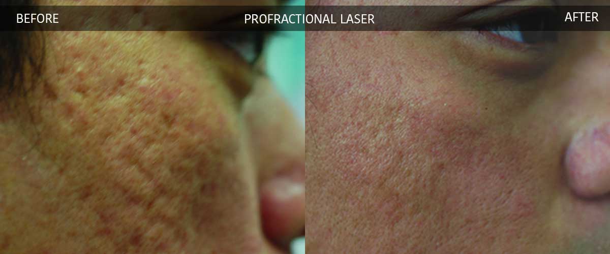 Profractional Laser - Cosmetic Treatments - Crows Nest Cosmetic & Vein Clinic Sydney