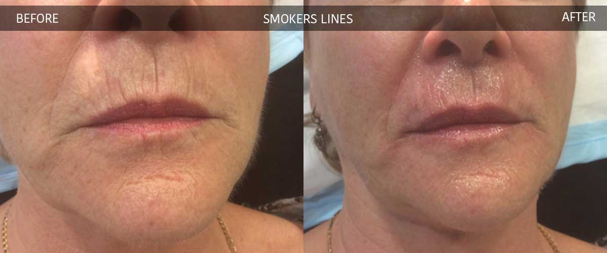 Smoker's Lines - Before and After - Crows Nest Cosmetic & Vein Clinic