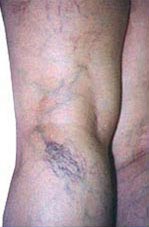 Spider Vein Removal - Before