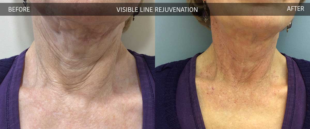 Visible Line Rejuvenation - Skin Treatments - Crows Nest Cosmetic Clinic