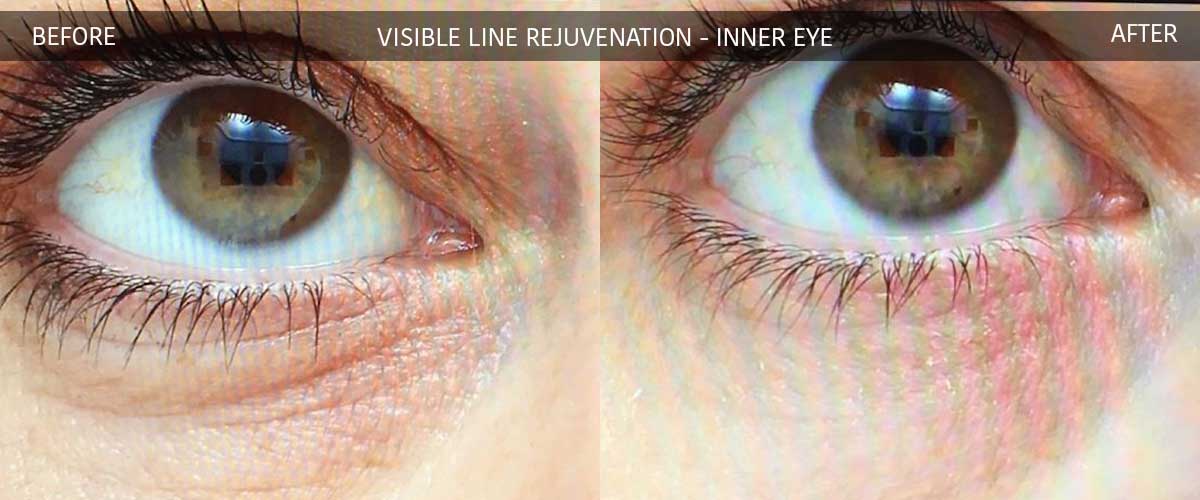 Visible Line Rejuvenation - Skin Treatments - Crows Nest Cosmetic Clinic