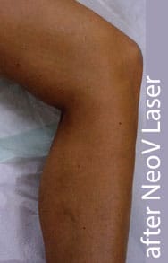 Varicose Vein Removal - Endovenous Laser Ablation After
