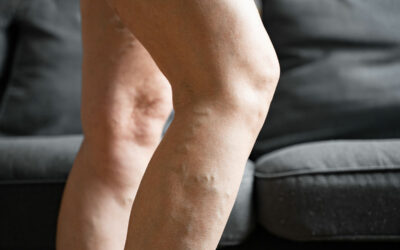 Varicose Veins in Pregnancy Treatment & Management Tips