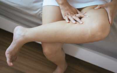 All About DVT and Varicose Veins
