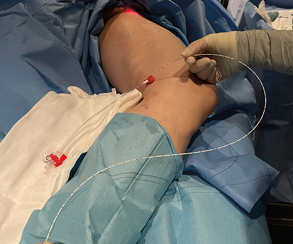 Varicose vein treatment endovenous laser ablation in progress