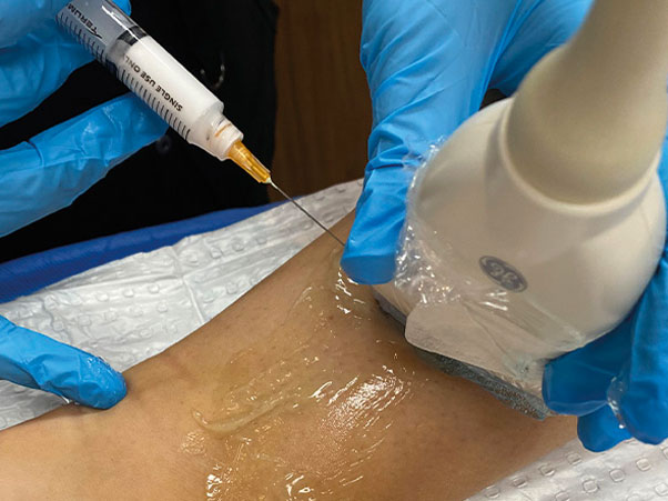 Varicose vein treatment ultrasound guided sclerotherapy in progress